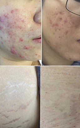 Acne Scars Treatment