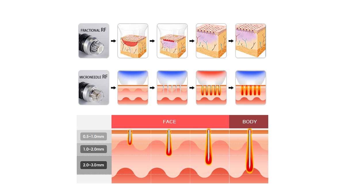 Professional Rf Microneedling Devices of Company