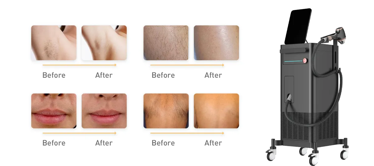 كيفية اختيار مورد جهاز إزالة الشعر بالليزر ديود موثوق